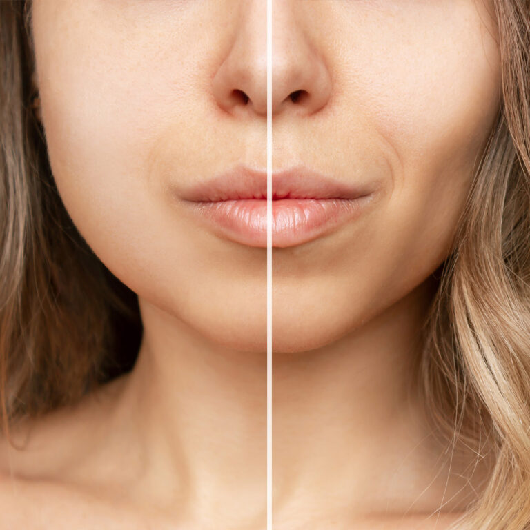 Buccal Fat Removal Procedure