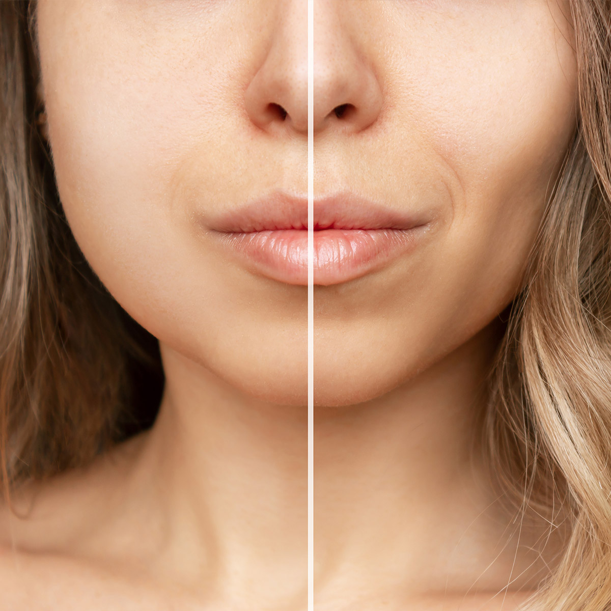 Buccal Fat Removal Procedure