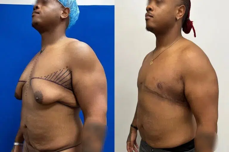 Gynecomastia Case Study - Patient Results