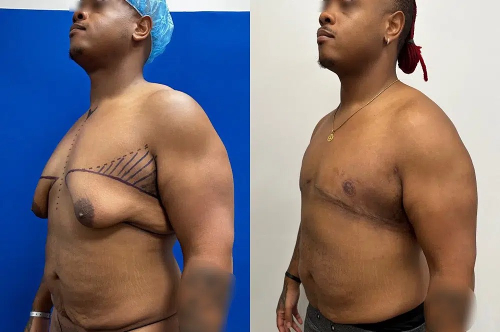 Gynecomastia Case Study - Patient Results