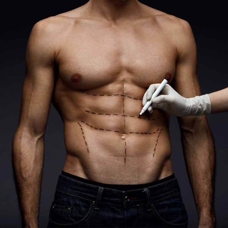 Gloved hand drawing dashed surgical markings on a man's abdomen before liposuction