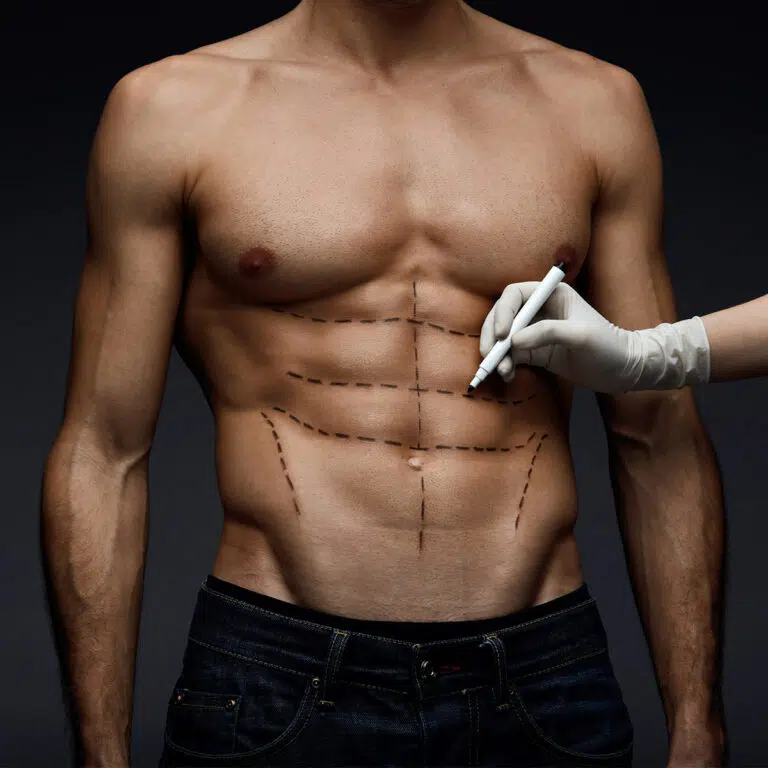 Gloved hand drawing dashed surgical markings on a man's abdomen before liposuction