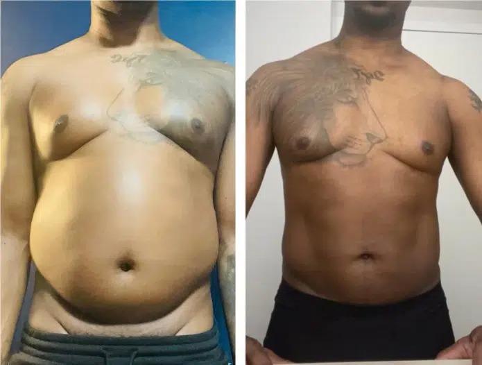 Male Liposuction Case Study - Patient Results