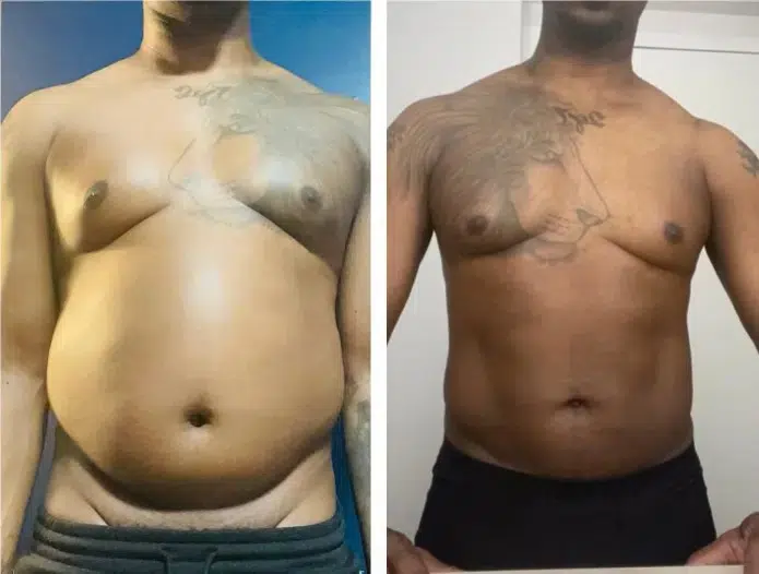 Male Liposuction Case Study - Patient Results