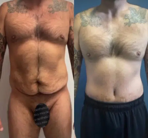 Male Tummy Tuck Case Study - Patient Results