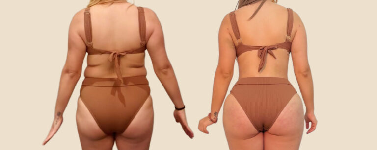 Before & After Gallery Results - Mia Aesthetics