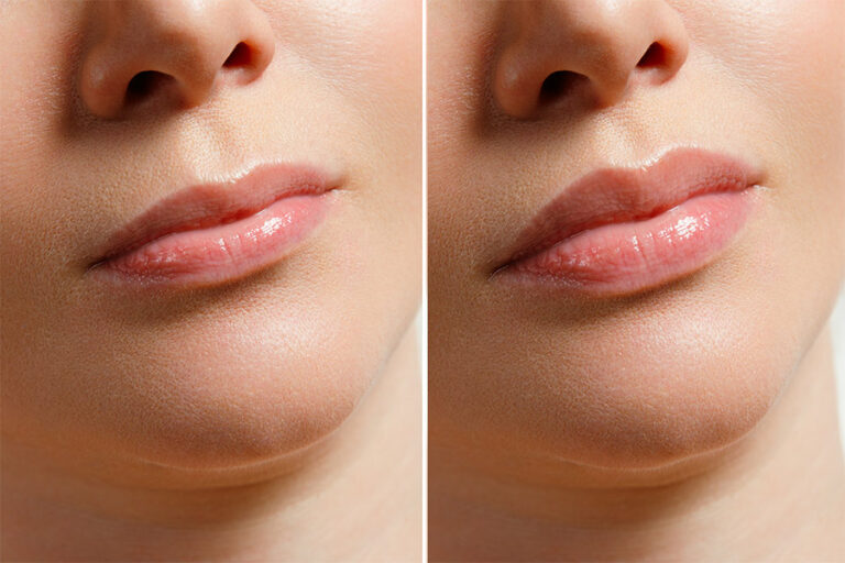 Lip Lift Results