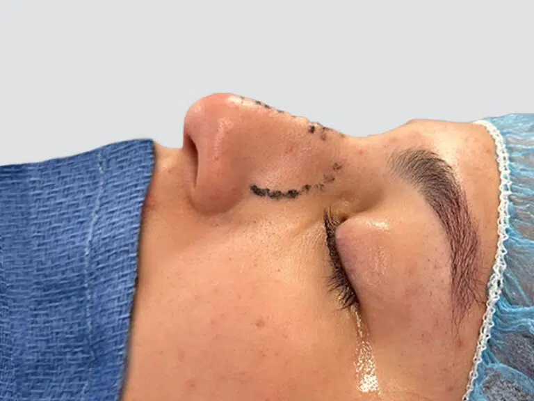 Rhinoplasty before photo – Mia Aesthetics