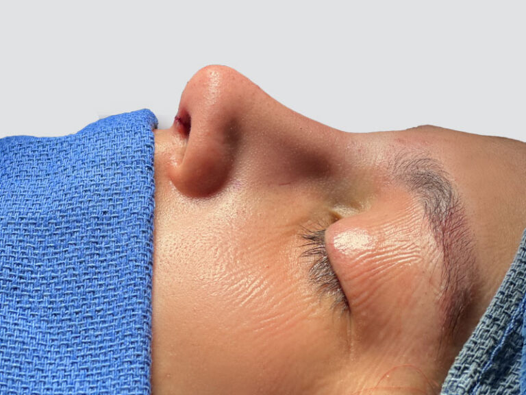 After Treatment – Case 7000 – Rhinoplasty